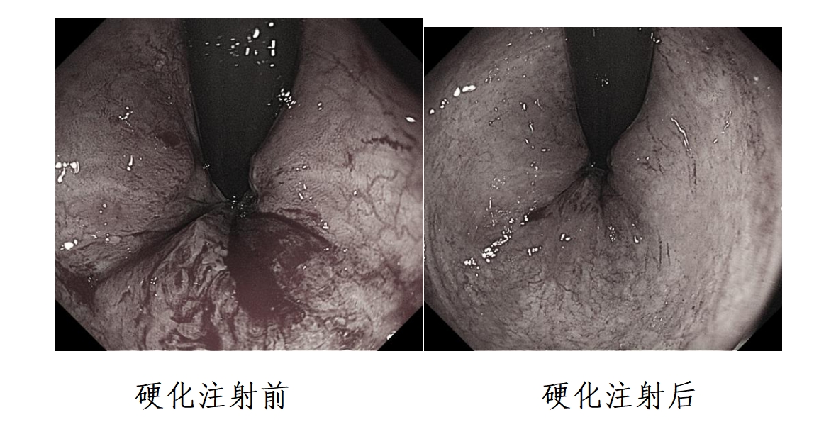 最新痔疮手术技术，舒适高效的医疗体验新篇章